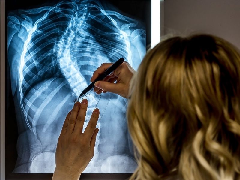 Scoliosis